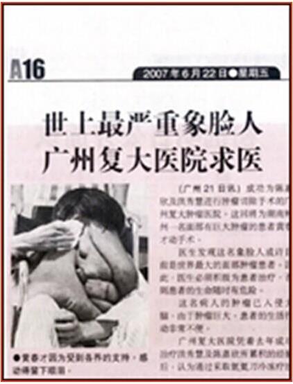 廣州腫瘤專(zhuān)家,黃春才成功治療案例