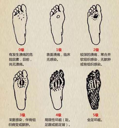 山東治療糖尿病足優(yōu)質(zhì)推薦醫(yī)院