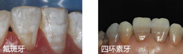 廣東省全民愛(ài)牙行動(dòng) 給大家講一下瓷貼面美學(xué)修復(fù)~