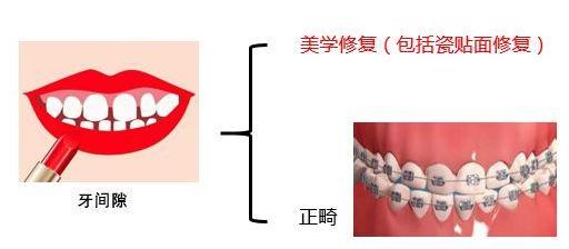 廣東省全民愛(ài)牙行動(dòng) 給大家講一下瓷貼面美學(xué)修復(fù)~