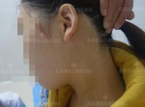 東莞博潤醫(yī)院白癜風(fēng)如何預(yù)約?為何白癜風(fēng)出現(xiàn)后要及時(shí)進(jìn)行治療