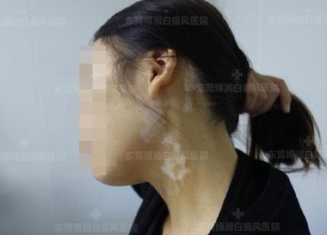 東莞博潤醫(yī)院白癜風(fēng)如何預(yù)約?為何白癜風(fēng)出現(xiàn)后要及時(shí)進(jìn)行治療