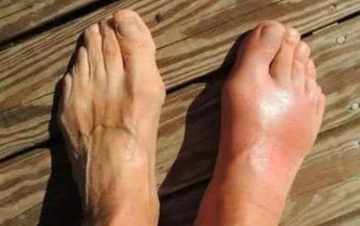 腳背疼是痛風嗎?腳背疼的原因有哪些?