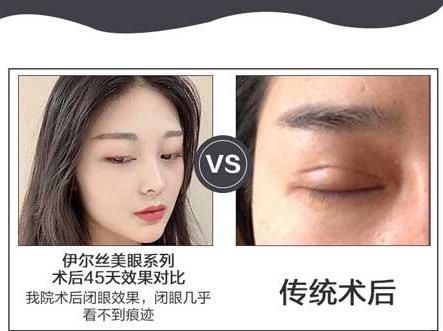 廣東韓妃整形于洪瑞割雙眼皮怎么樣 專(zhuān)研精細(xì)化眼部整形