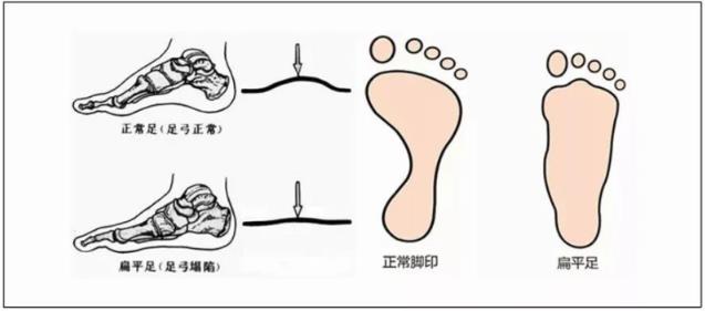 緩解扁平足的疼痛,穿著矯正鞋墊進(jìn)行運(yùn)動(dòng)鍛煉,更有效