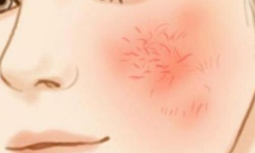 激素臉可以根治嗎?激素臉有哪些表現(xiàn)?