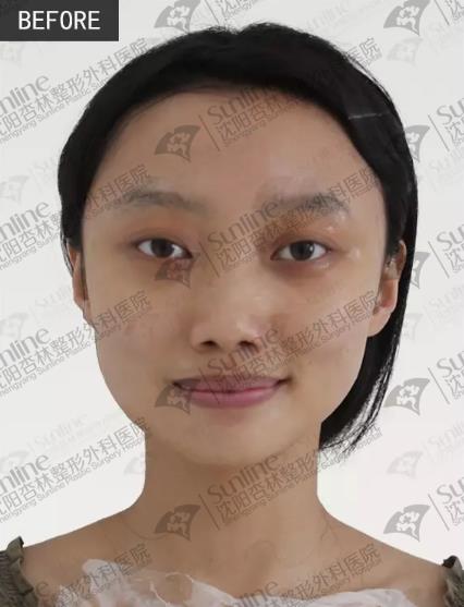 沈陽(yáng)杏林整形醫(yī)院玻尿酸隆鼻如何