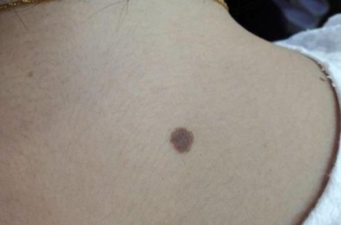 黑色素瘤病變是怎樣的?為什么會得黑色素瘤?