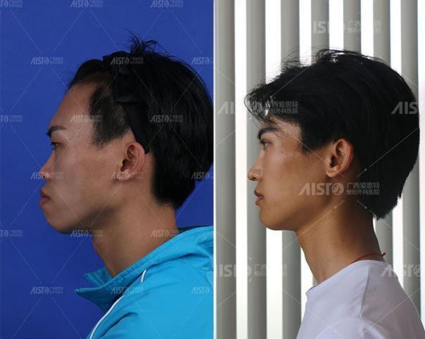 廣西愛思特整形外科醫(yī)院怎么樣 頜面外科專注正頜手術