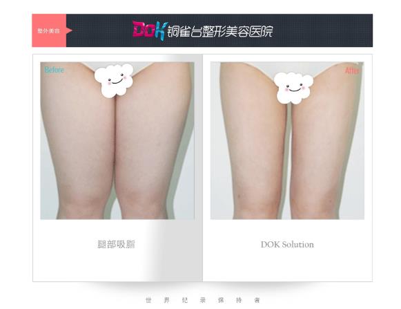 昆明銅雀臺(tái)整形醫(yī)院左萬(wàn)昌主任吸脂如何 任何肥胖部位都可以吸脂?