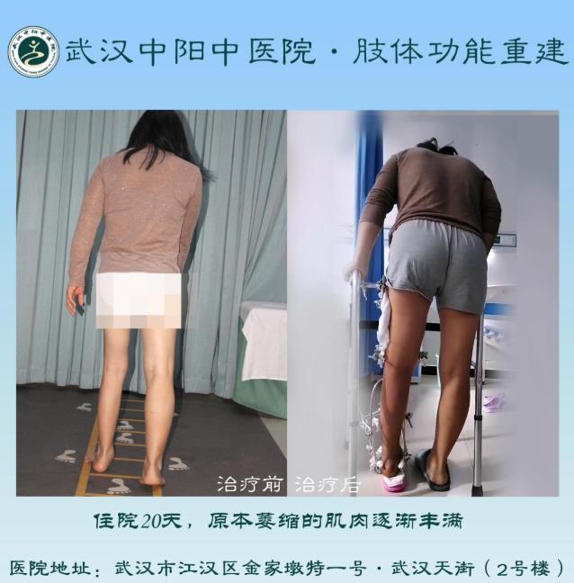 50年“馬蹄足”苦不堪言,中醫(yī)骨傷·矯形技術(shù)助力放平雙腳,平穩(wěn)行走