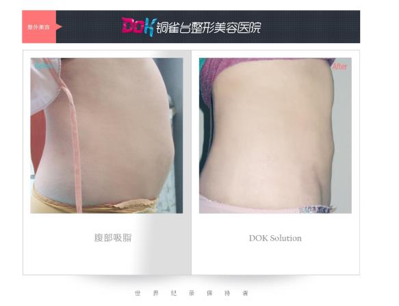 昆明銅雀臺(tái)整形醫(yī)院左萬(wàn)昌主任吸脂如何 任何肥胖部位都可以吸脂?