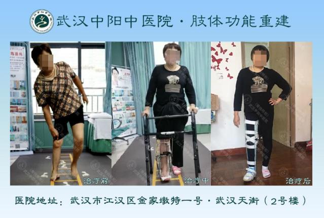 50年“馬蹄足”苦不堪言,中醫(yī)骨傷·矯形技術(shù)助力放平雙腳,平穩(wěn)行走
