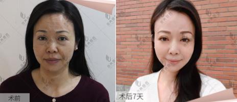 京典麗園不開刀去眼袋權(quán)威嗎?不開刀真的好嗎?