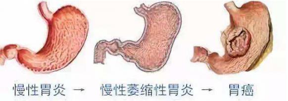 呼市東大肛腸醫(yī)院 你從來(lái)不知道,胃癌離你有多近!消化科主任教你急剎車!