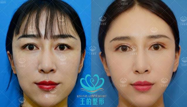 雙眼皮修復(fù)有多難?云南王海木院長告訴你