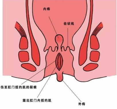 呼市東大醫(yī)院 出現(xiàn)這個(gè)癥狀,小心肛門不保