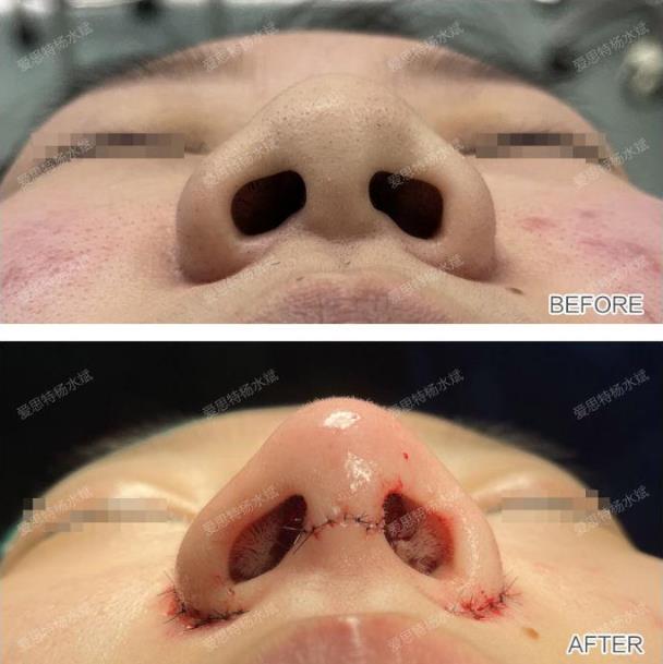 武漢愛思特整形醫(yī)院隆鼻專業(yè)嗎?楊水斌院長分享精致的微駝峰鼻,效果棒棒噠!