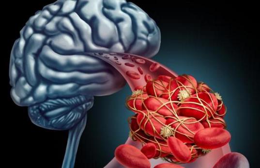 腦栓塞和腦血栓有什么區(qū)別?腦栓塞的癥狀是什么