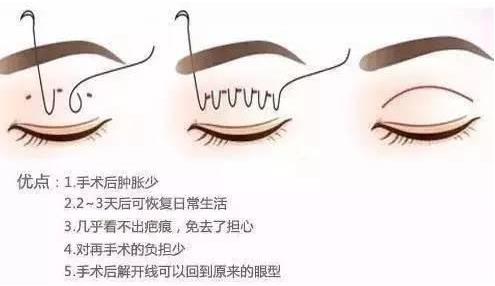 上海玫瑰整形鄒功偉醫(yī)生雙眼皮技術(shù)如何 專業(yè)整形品質(zhì)保證