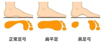 兒童扁平足怎么辦,穿著合適的矯正鞋干預(yù)