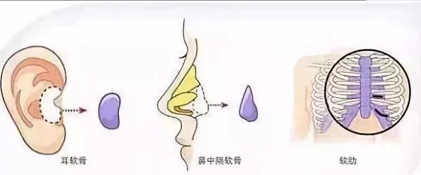 浙江隆鼻醫(yī)院 上海玫瑰整形醫(yī)院隆鼻怎么樣 美鼻提升顏值