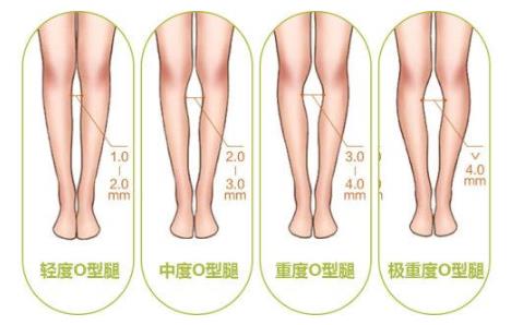 北京知音醫(yī)療美容李奇軍院長專業(yè)O型腿矯正