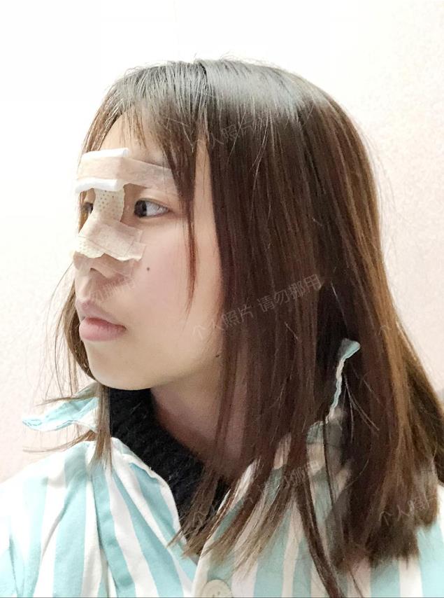 武漢楊水斌做肋軟骨鼻綜合怎么樣?來(lái)看看精品案例更直觀!
