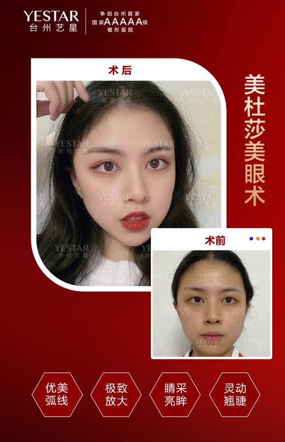 臺(tái)州藝星整形醫(yī)院:美杜莎美眼術(shù)—拯救你的無(wú)神小眼!