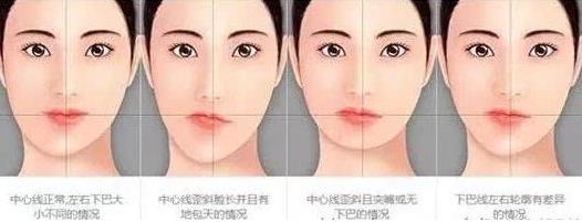 除了臉方,這種情況也可以做下頜角切除手術(shù)