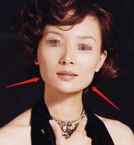 除了臉方,這種情況也可以做下頜角切除手術(shù)