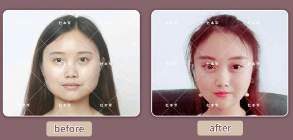 除了臉方,這種情況也可以做下頜角切除手術(shù)
