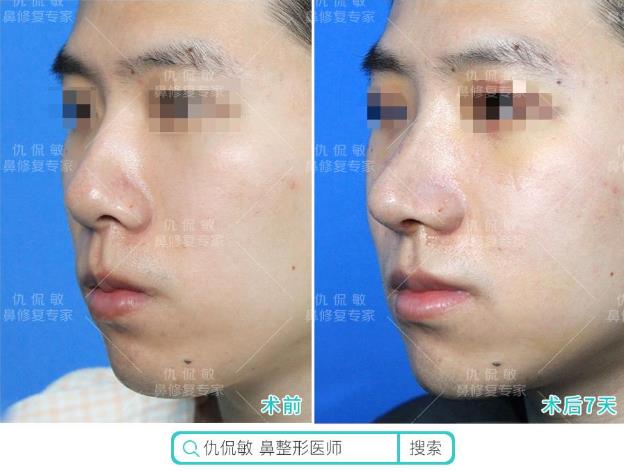 仇侃敏:鼻整形恢復(fù)期常見問題