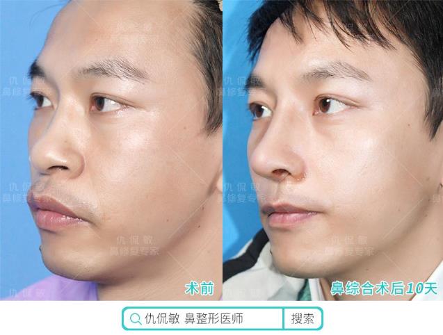 仇侃敏:鼻整形恢復(fù)期常見問題