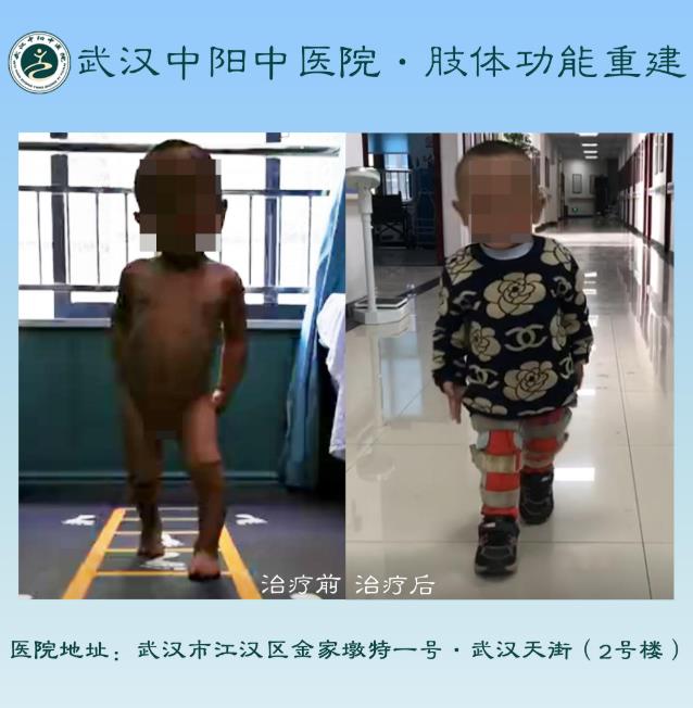 武漢中陽(yáng)矯形·骨科矯形技術(shù)丨3-14歲小兒骨科矯形圖集