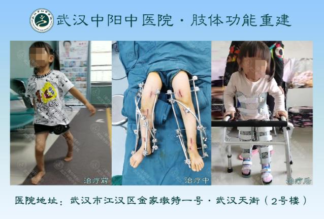 武漢中陽(yáng)矯形·骨科矯形技術(shù)丨3-14歲小兒骨科矯形圖集