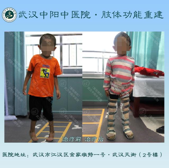 武漢中陽(yáng)矯形·骨科矯形技術(shù)丨3-14歲小兒骨科矯形圖集