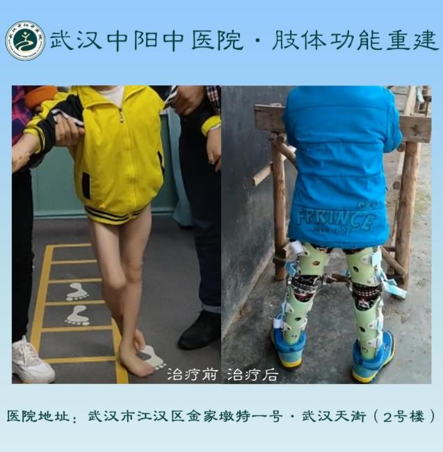 武漢中陽(yáng)矯形·骨科矯形技術(shù)丨3-14歲小兒骨科矯形圖集