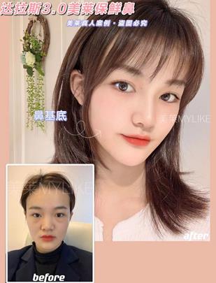 鄭州美萊隆鼻技術(shù)怎么樣 精湛技藝 附真人隆鼻案例對比