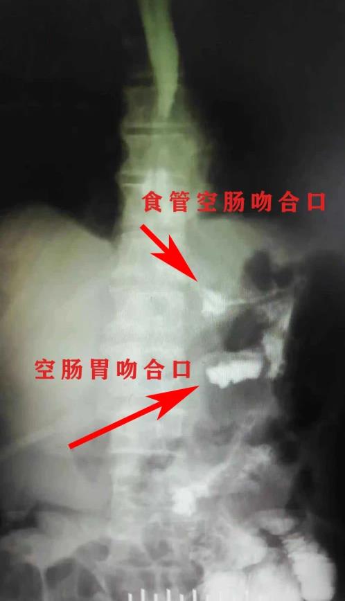 見(jiàn)招拆招 | 我院成功實(shí)施一例食管胃結(jié)合部癌切除雙通道吻合術(shù)