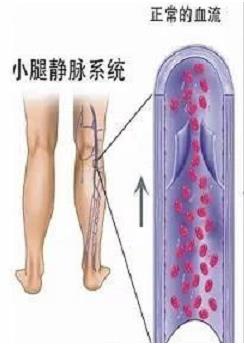 泉州成功醫(yī)院看下肢靜脈曲張好不好 療效來自專業(yè)的技術(shù)