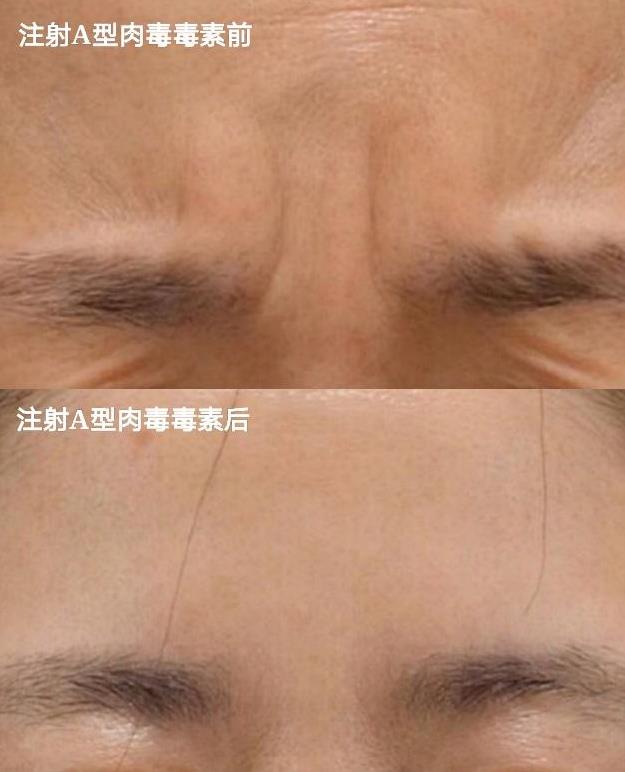 怕痛怕動(dòng)刀?王的整形楊汝教你午休一刻搞定微整形