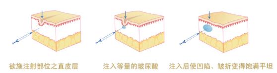 怕痛怕動(dòng)刀?王的整形楊汝教你午休一刻搞定微整形