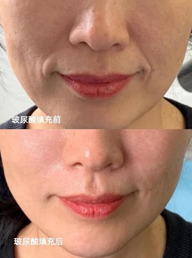 怕痛怕動(dòng)刀?王的整形楊汝教你午休一刻搞定微整形