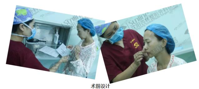 面部填充案例,沈陽(yáng)自體脂肪填充案例