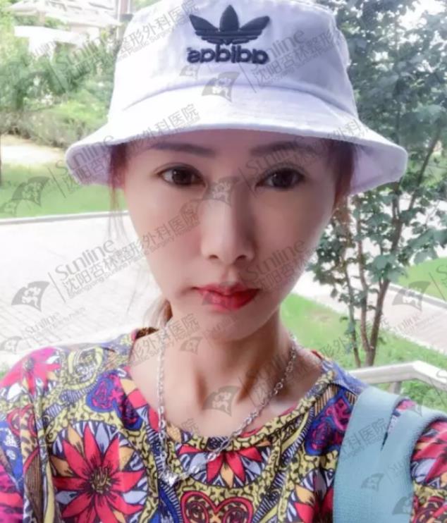 面部填充案例,沈陽(yáng)自體脂肪填充案例