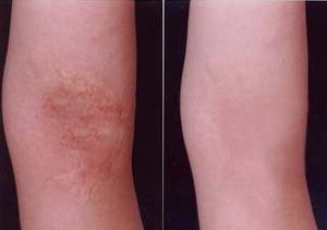 北京南加整形疤痕修復哪里治療疤痕外傷疤痕怎么處理效果好