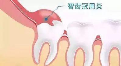 廣東省全民愛(ài)牙行動(dòng)——牙床腫痛的癥狀