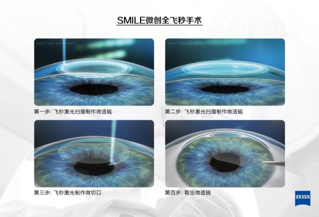 近視考生填報專業(yè)很吃虧?!鄭州尖峰眼科醫(yī)院助你摘鏡圓夢