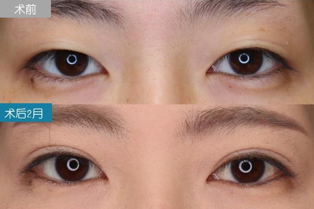 圣心美容丁奕如醫(yī)生解析:想要get自然的日式雙眼皮,需要注意哪幾點?